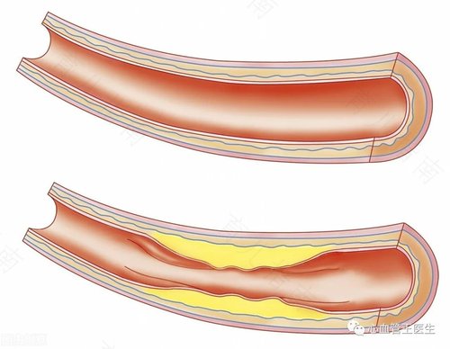 脑动脉粥样硬化能活多久 脑动脉粥样硬化能活多久