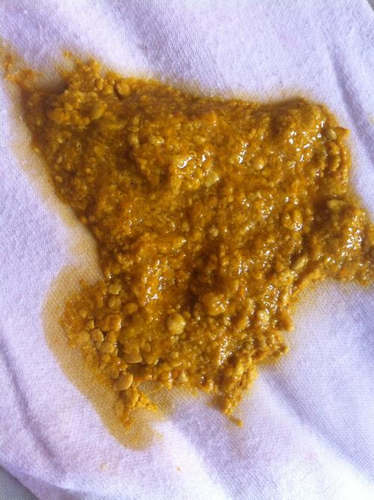 大便不正常是怎么回事? 大便不正常是怎么回事?