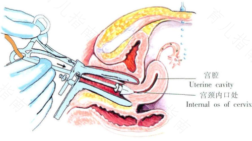 宫颈管出血怎么治疗? 宫颈管出血怎么治疗?