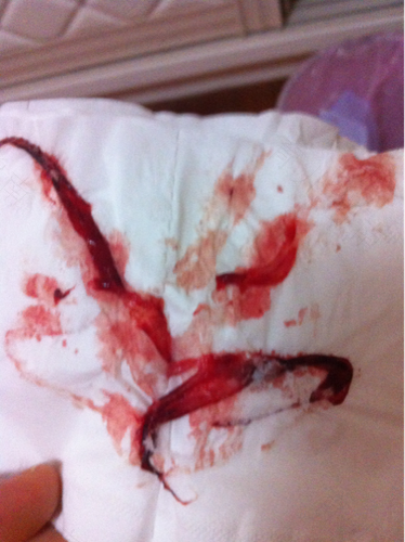 做完人流一周后肚子疼是怎么回事 做完人流一周后肚子疼是怎么回事