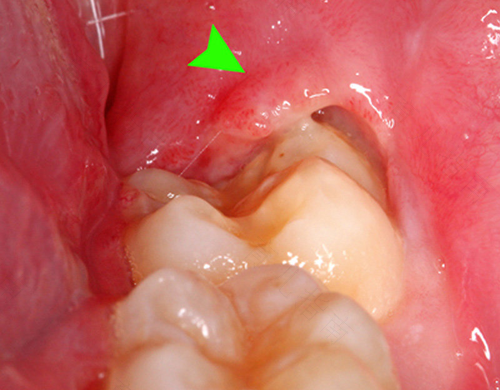 牙龈肿痛怎么治疗? 牙龈肿痛怎么治疗?