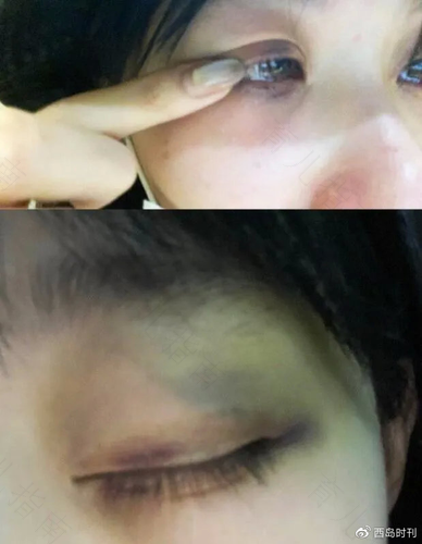 内眼窝发青是怎么回事 内眼窝发青是怎么回事