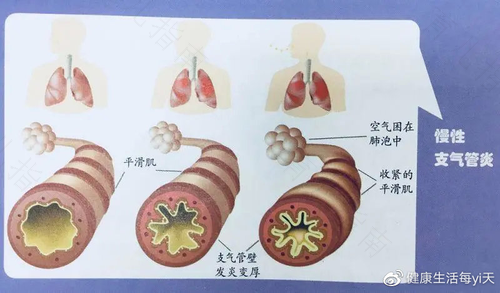 慢性支气管炎的症状是什么症状 慢性支气管炎的症状是什么症状