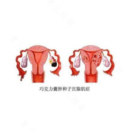 宫腔内多发性囊肿怎么办 宫腔内多发性囊肿怎么办