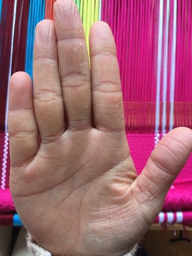 产后手心干燥是怎么回事 产后手心干燥是怎么回事