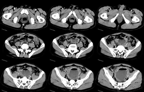 盆腔ct能检查出什么 盆腔ct能检查出什么