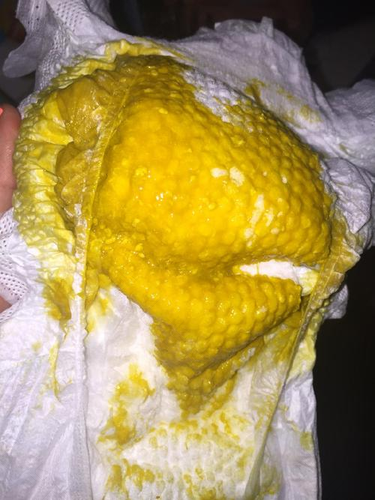 突然间拉肚子怎么回事? 突然间拉肚子怎么回事?