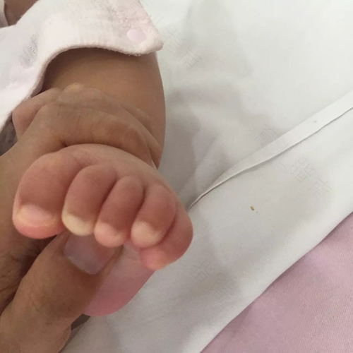 脑瘫儿睡觉手会张开吗 脑瘫儿睡觉手会张开吗