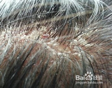 冬天身上脱皮屑是怎么回事