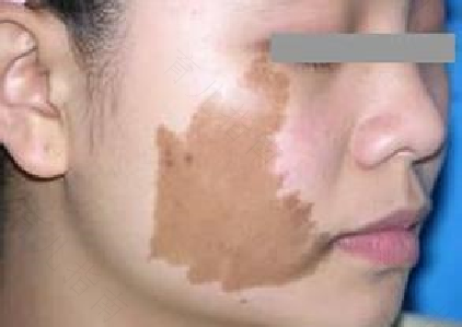 秋季是治疗胎记最佳时候吗? 秋季是治疗胎记最佳时候吗?