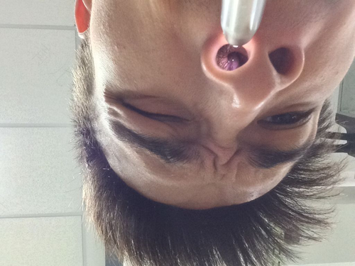 左侧鼻子严重堵塞怎么办 左侧鼻子严重堵塞怎么办