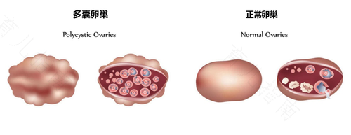 卵巢多囊能自愈吗 卵巢多囊能自愈吗