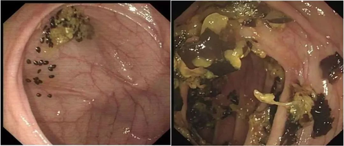 刚做完肠镜能吃饭吗 刚做完肠镜能吃饭吗