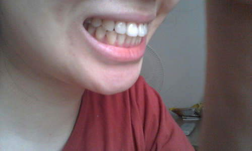 30岁门牙外凸怎么办 30岁门牙外凸怎么办