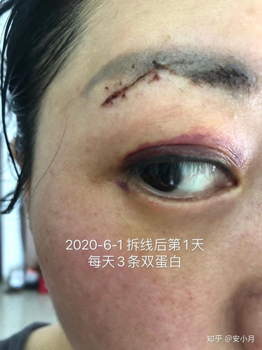 手外伤拆线后表皮裂开怎么办