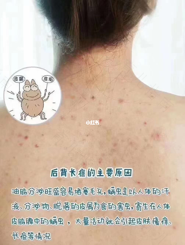 前胸后背长疮是怎么回事 前胸后背长疮是怎么回事