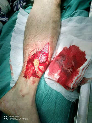 左胫腓骨骨折几级伤残钢板 左胫腓骨骨折几级伤残钢板