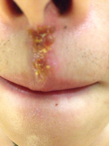 鼻子上火是什么引起的