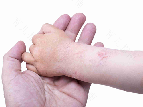 玫瑰湿疹是什么引起的 玫瑰湿疹是什么引起的