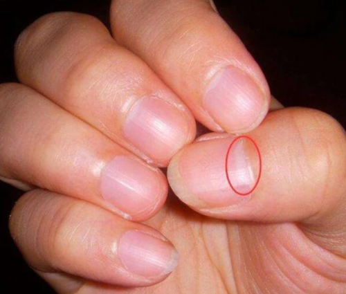 指甲没有月牙了是什么原因 指甲没有月牙了是什么原因