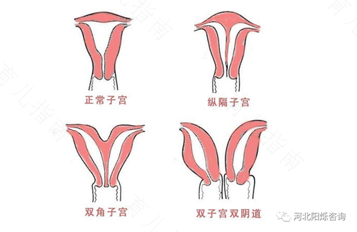 子宫歪向左边了怎么办 子宫歪向左边了怎么办