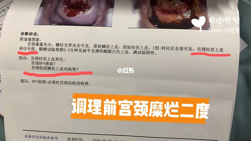 宫颈糜烂3度能治愈吗 宫颈糜烂3度能治愈吗
