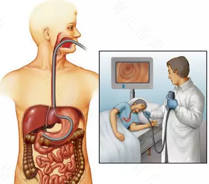 肺癌患者可以做胃镜吗 肺癌患者可以做胃镜吗