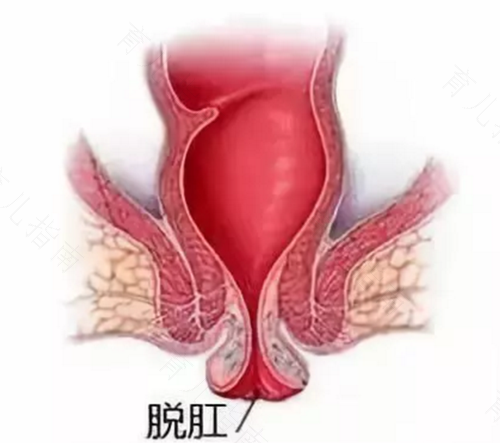 肛门脱肛怎么治 肛门脱肛怎么治