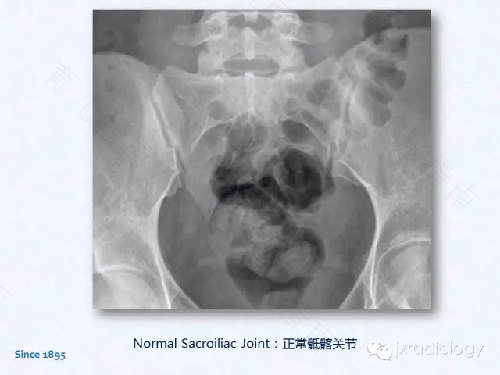 骶髂关节融合会怎样