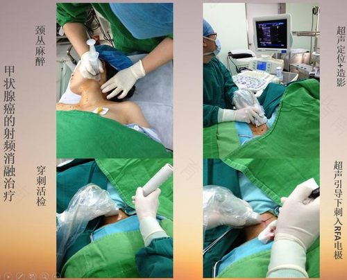 腋窝淋巴结肿大穿刺怎么做 腋窝淋巴结肿大穿刺怎么做