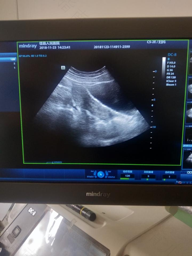 子宫内膜薄有什么症状体现 子宫内膜薄有什么症状体现