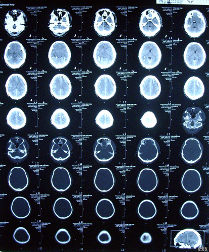 闭合性颅脑损伤后遗症潜伏期