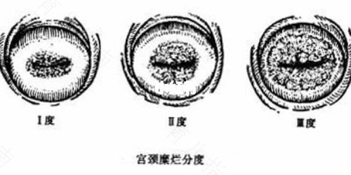 宫颈肥大,轻糜样改变 宫颈肥大,轻糜样改变
