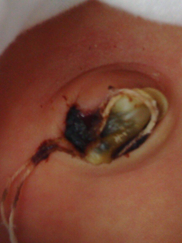 十四天新生儿肚脐出血怎么办 十四天新生儿肚脐出血怎么办