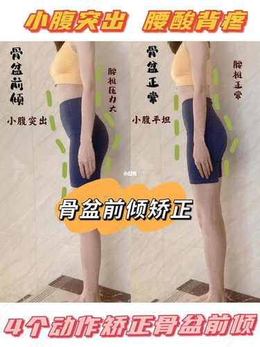 成人骨盆前倾能矫正过来吗 成人骨盆前倾能矫正过来吗