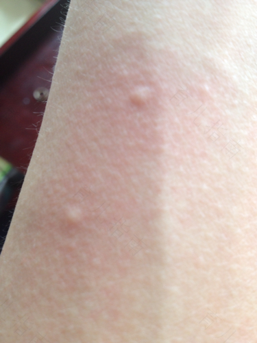 身上到处都痒怎么回事吃什么药 身上到处都痒怎么回事吃什么药