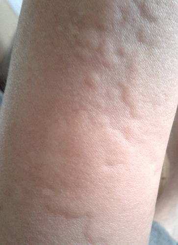 过敏了怎么办最快方法止痒 过敏了怎么办最快方法止痒