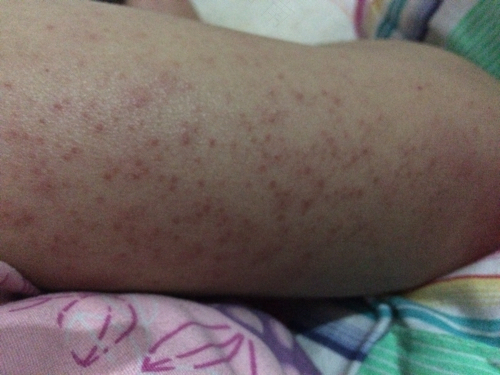 酒精过敏危险吗? 酒精过敏危险吗?