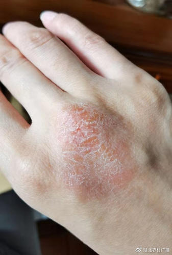 儿童手上起红疹是怎么回事 儿童手上起红疹是怎么回事