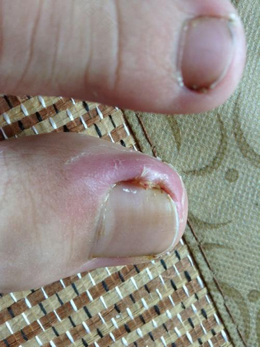 新生儿甲沟炎红肿怎么办 新生儿甲沟炎红肿怎么办