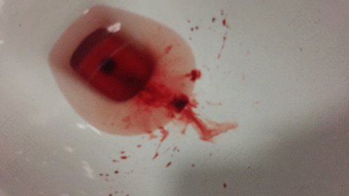 药流第二天出血正常吗肚子疼 药流第二天出血正常吗肚子疼