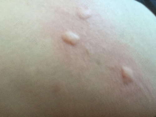 身上过敏起包很痒怎么办 身上过敏起包很痒怎么办