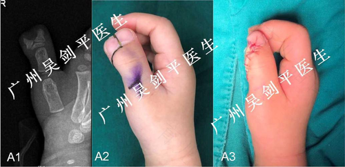 短指畸形原因是什么 短指畸形原因是什么