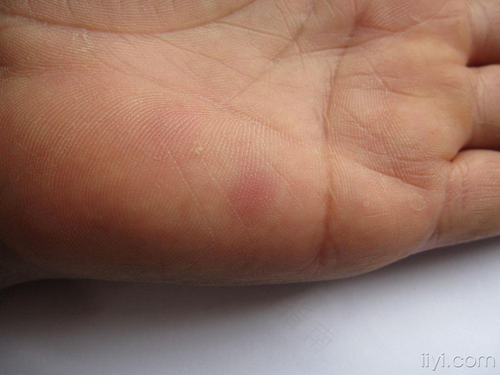 成人手心脚心发黄是怎么回事 成人手心脚心发黄是怎么回事