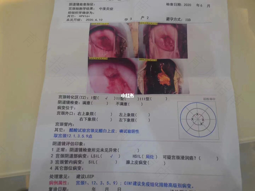 宫颈癌高度病变要怎么办