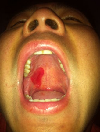 长期长口腔溃疡怎么办 长期长口腔溃疡怎么办