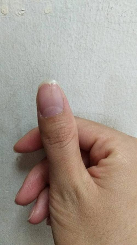 大拇指有条黑线怎么回事 大拇指有条黑线怎么回事