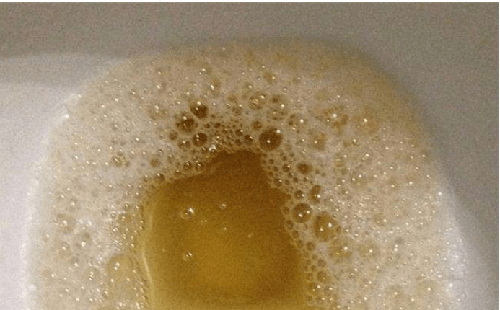 尿液发黄是怎么回事男性 尿液发黄是怎么回事男性