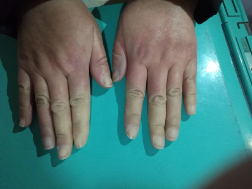 结缔组织病通常有共同的症状,而且该病涉及心脏,皮肤等多个系统和组织