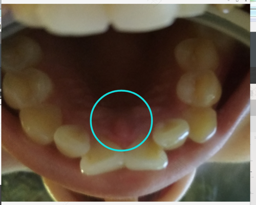 下牙牙龈痒是怎么回事 下牙牙龈痒是怎么回事